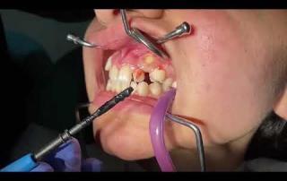 Gömülü köpek dişi açılması 6 Gömülü köpek dişi açılması 6