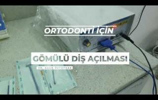Gömülü Köpek Dişi Açılması 2 | Dr. Kaan Öztoprak 3 Gömülü Köpek Dişi Açılması 2 | Dr. Kaan Öztoprak 3
