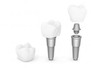 diş implantı, ankara implant