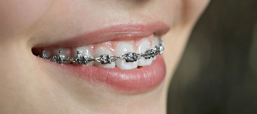 Ortodonti Dis Teli Dent Ankara