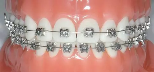 diş teli ortodonti