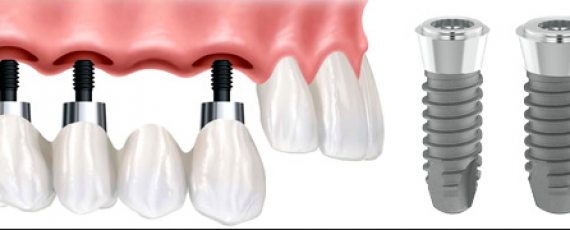 implant Diş implantı Dent Ankara yapay diş uygulaması
