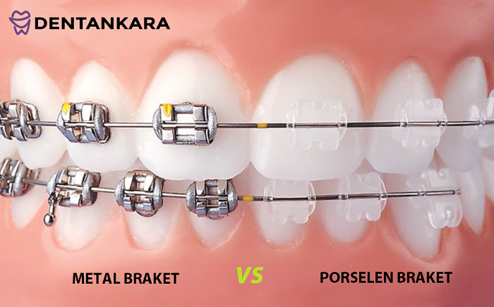 Ortodonti Dis Teli Dent Ankara
