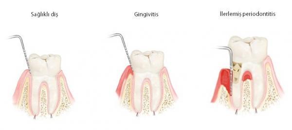 Diş Eti Tedavisi Dent Ankara